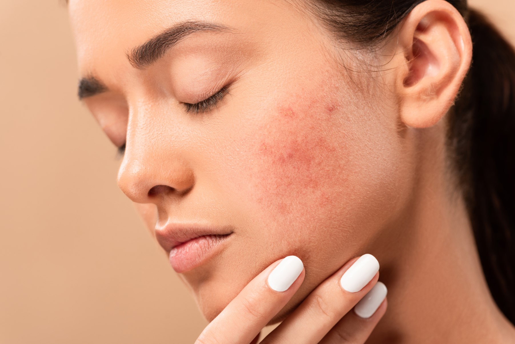 Skin Conditions