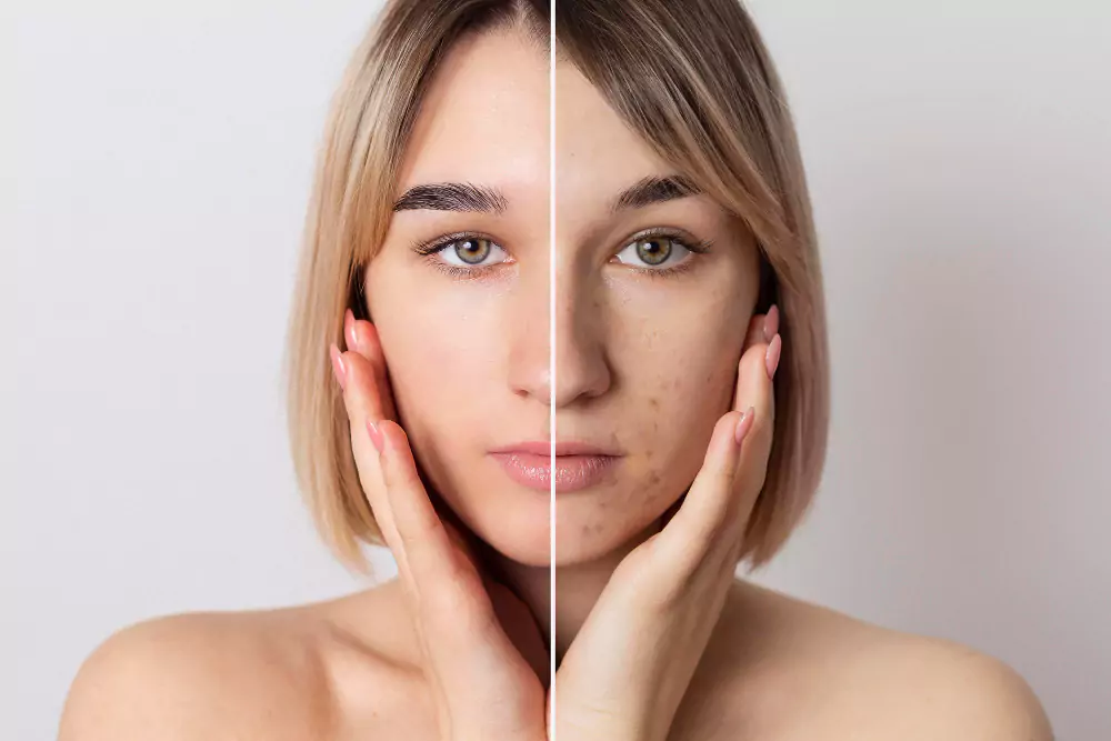 Acne Treatment